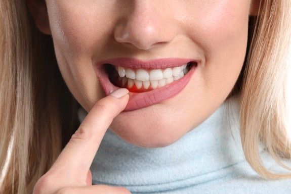 Nahansicht einer Frau, die Ihre Lippe herunterzieht, um ihr rotes Zahnfleisch zu zeigen